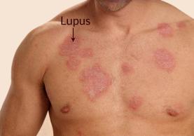 Associação de Doentes com Lúpus alerta para o impacto da doença com actividades de sensibilização